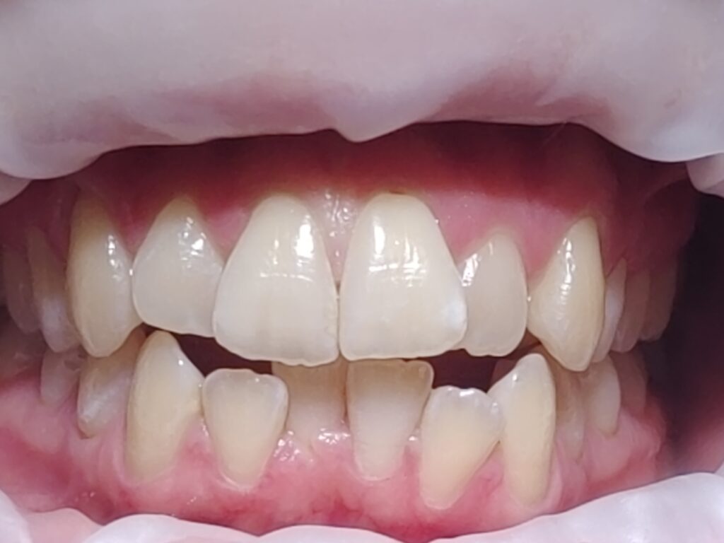 Hampaat ennen Invisalign hoitoa. 